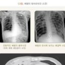 급성폐렴 증상 원인 성인 폐렴 초기증상 치료 방법 이미지