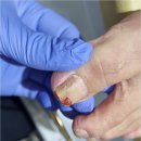 더케어 | 의정부내성발톱 관리 대성공 후기 더케어 네일앤스파