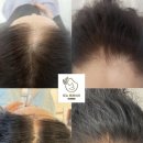 도노포레스타 두피케어(산본점)