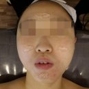 메가엠지씨커피평택비전고 | 평택웨딩관리 소사벌 봄날에스테틱에서 여드름흉터 mts 관리 받았어요