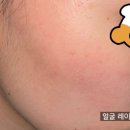 수원 피부과 얼굴 레이저 제모 후기 ᶻ 𝗓 𐰁 .ᐟ ⊹ 1회차 ~ing