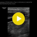담낭 선근종증(adenomyomatosis,GB) 이미지