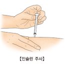 당뇨합병증 : 당뇨병성 족부(DM foot ulcer) 이미지