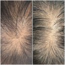 (주)비원비 | 어머니께 두피 타투 해드리고 칭찬받은 후기. 탈모보정 탈모고민 효도선물