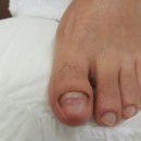 레푸스네일 이미지