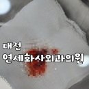 연세대천외과의원 | 대전 연세화사외과의원☆ 양성종양,표피낭종 수술 후기