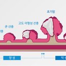 용종 제거술(내시경) 이미지