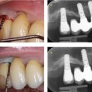 미소를심는서울치과의원 | 수원 임플란트 치과 , 수술 후 임플란트 주위염 조심해야하는 이유