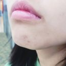 함익병피부과의원 | 한티역 함익병 피부과 의원 3번째 방문 후기 아이 여드름 치료