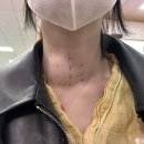 삼일병원 | 갑상선 결절 수술 후기 입원편(삼일병원)