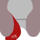 운정문항외과의원 | 급성 혈전성 외치핵 증상 이거 때문에 급히 수술한 후기 [파주 운정문항외과 야당 항문외과]