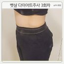 일산 비만클리닉 뱃살 다이어트주사 3회차 내돈내산 후기