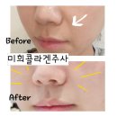 강남역피부과 팔자주름에 탁월한 미희콜라겐주사 후기