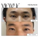 뷰리프성형외과의원 | [대전 뷰리프성형외과] 남자 매몰 눈수술 후기