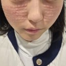 명동건강사우나 | 서울역피부과 명동 리쥬란 잘하는 곳 | 2cc 첫시술 후기 + 가격, 통증, 엠보, 멍, 효과 솔직 리뷰