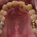 e-라인치과기공소 | 양평교정치과, 반대교합 + 상악 덧니 문제가 복합되었던 환자 후기