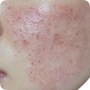 (주)오가나셀 | [여드름 흉터 치료 4회차 - 오가나셀피부과 마곡점] 이제 곧 끝난다구요?