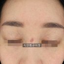 바즈바이오메딕 주식회사 | 인천 큐어젯 포텐자 쥬베룩 코 여드름 패인 흉터 수두 대상포진 상처 치료 시술 전후 후기