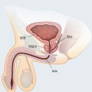 전립선암이란 이미지