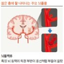 삼겹살·짜장면 좋아하는 20~30대 추운 날 뇌졸중 조심하세요 이미지