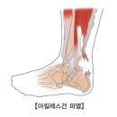 아킬레스 건 파열[Acute achilles tendon rupture근골격질환] 이미지