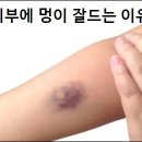 멍이요 | 피부에 멍이 잘드는 이유 상세 설명