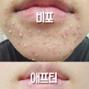 태평양화장품 - 강동구 천호대로157길 19 | 모낭염 화장품 추천 조합 입주변 트러블 극복 후기