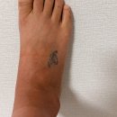 부산 문신 제거 서면 잘하는곳 후기 지긋지긋한 타투