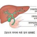 담관암 (Cholangiocarcinoma) 이미지