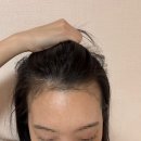 3400 | 1. 여자 m자 헤어라인 비절개 모발이식 3400모 수술 직후 후기 🧑‍🦲