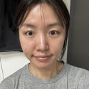 생각나는한의원 | 로담한의원 후기 모공+새살침 내돈내산후기(4회차)