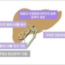 담석증초기 담석증 원인 이미지