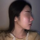 강남 코재수술 후기 리셋성형외과 2주차인데 벌써 이 정도