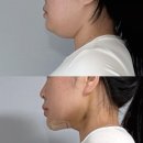 신정형외과의원 앞 | 강남 이중턱살제거 근육묶기 내돈내산 일주일 변화 후기 리모성형외과