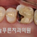네츄럴치과기공소 네이버블로그