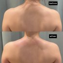 메디365 | 광주 웨딩관리, 극초단파 리프팅으로 팔뚝살 파괴 후기 | 365메디스킨