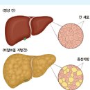 지방간 원인 증상 치료 방법 예방 지방간에 좋은음식 이미지