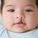 구순구개열[cleft lip and cleft palate] 이미지