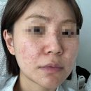 7 (드디어 이소티논 복용 시작? 이소티논 후기? 이소티논 명현현상? 이소티논 일주일차? 이소티논...