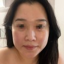 [청담] 윤곽 리프팅 관리, *수정에스테틱 청담*에서 피부관리 받은 후기