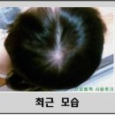 (주)프로메톡 | 심한 지성과 붉은 두피의 정수리 탈모 개선후기 (피부과추천 프로메톡 사용 후기)