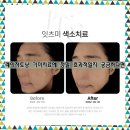 동탄레이저토닝 기미치료에 정말 효과적일지 궁금하다면