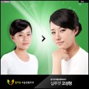 압구정서울성형외과 네이버블로그