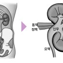 기타 암 - 신우요관암 이미지