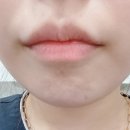 뉴라인성형외과의원 | 부산 서면 입꼬리필러 후기 입술 필러 원조 맛집 뉴라인성형외과