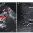 Hepatic cyst 이미지