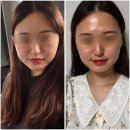 송도피부과 예신관리 추천 &lt;콜라스터포텐자후기&gt; :: 포어타이트닝, 스킨부스터 7일차 후기
