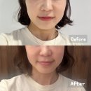 디오피부과의원 | 디오디피부과 청담티타늄리프팅 받고 온 후기