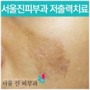 인지반점 이미지