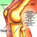 오스굿씨 병(Osgood-Schlatter) 이미지